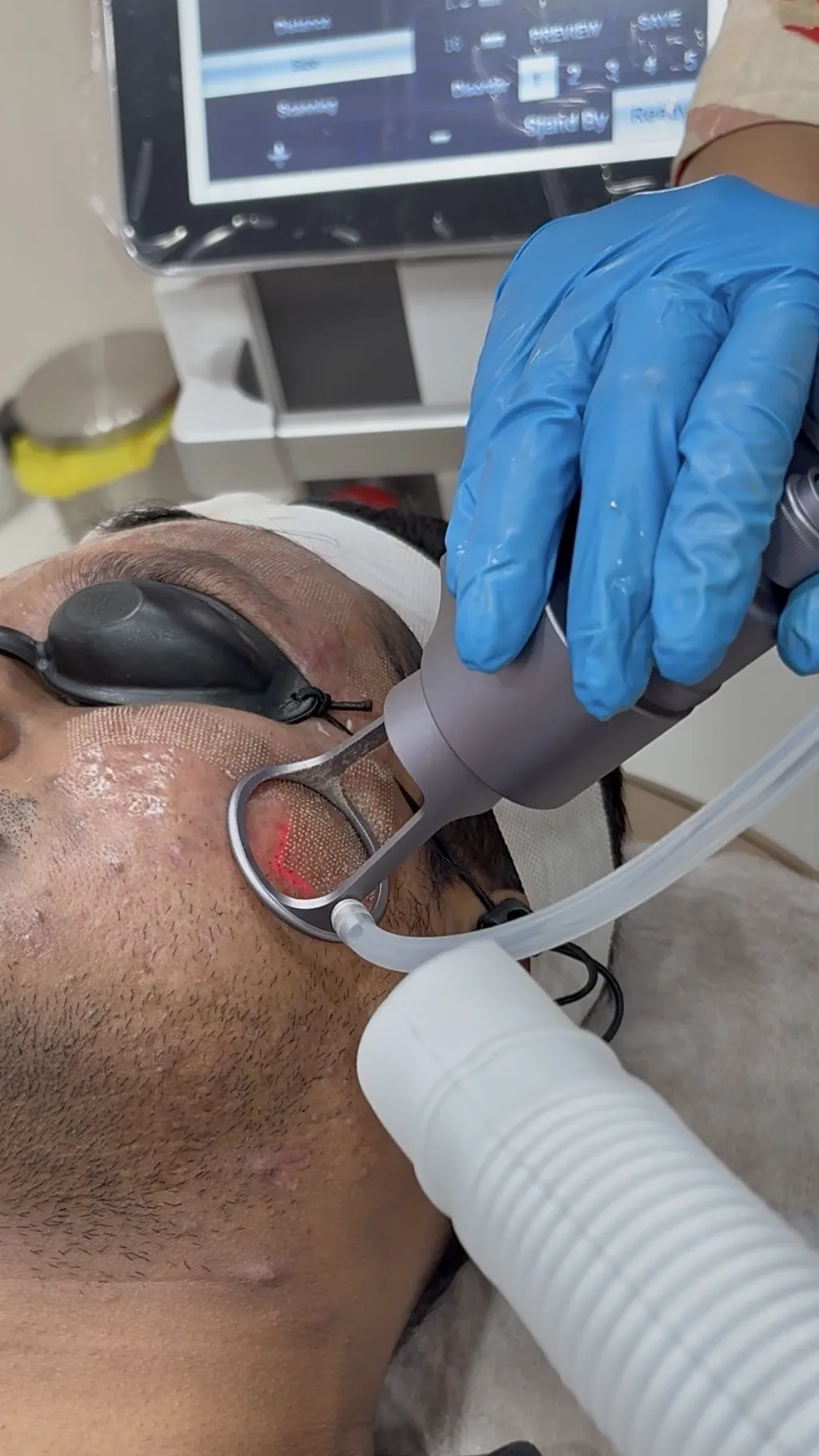 CO2 Laser for Scars Result