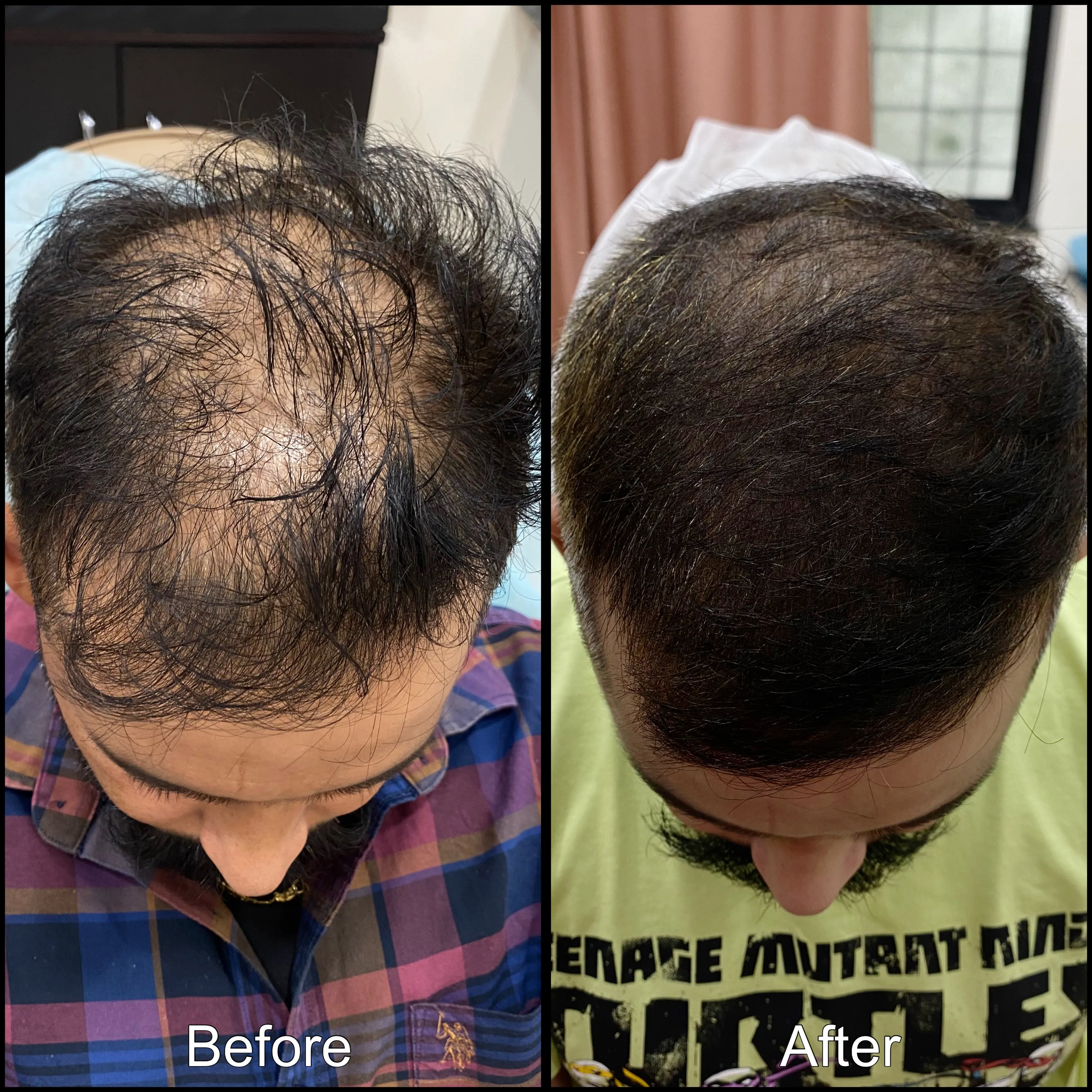Male Pattern Balding Results