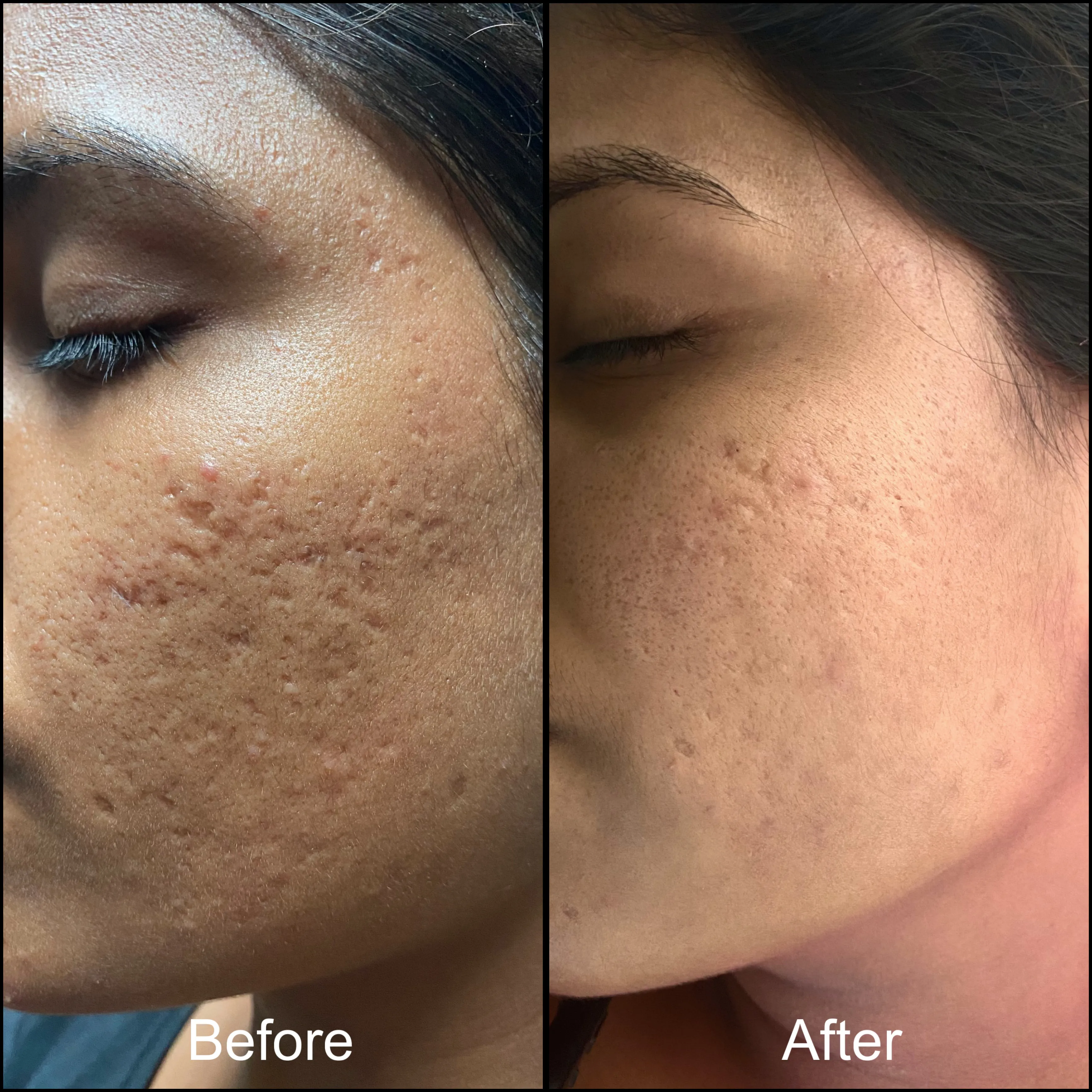 Acne Scar Removal Treatment