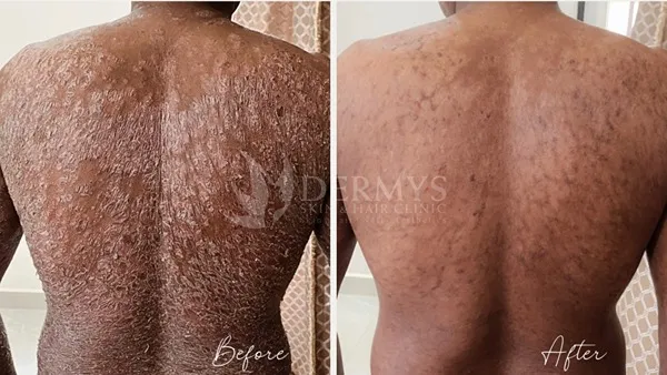 Treatments for psoriasis,vitiligo,fungal infections available at Dermys Clinic Nagpur