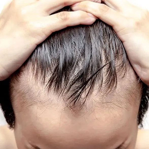 Hair loss problem man with a bald head