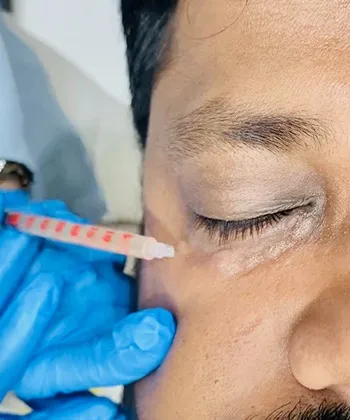 FDA approved injections for forehead lines being given at Dermys Clinic Nagpur