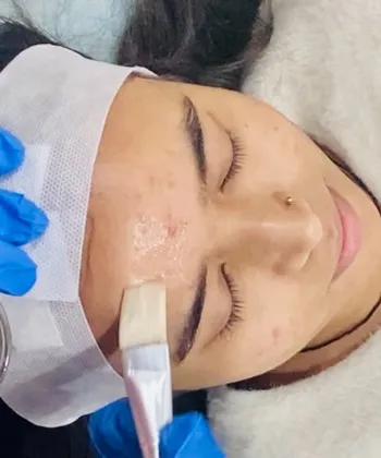 Chemical peeling being done at Dermys Clinic Nagpur