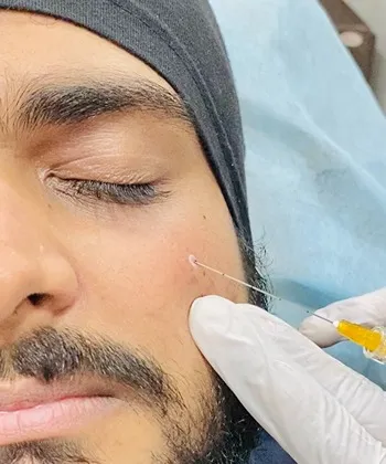 Different fillers procedures available at Dermys Clinic Nagpur
