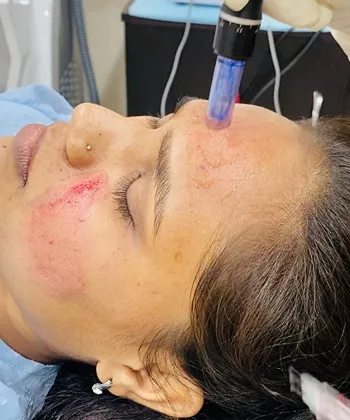 Microdermabrasion being done at Dermys Clinic Nagpur